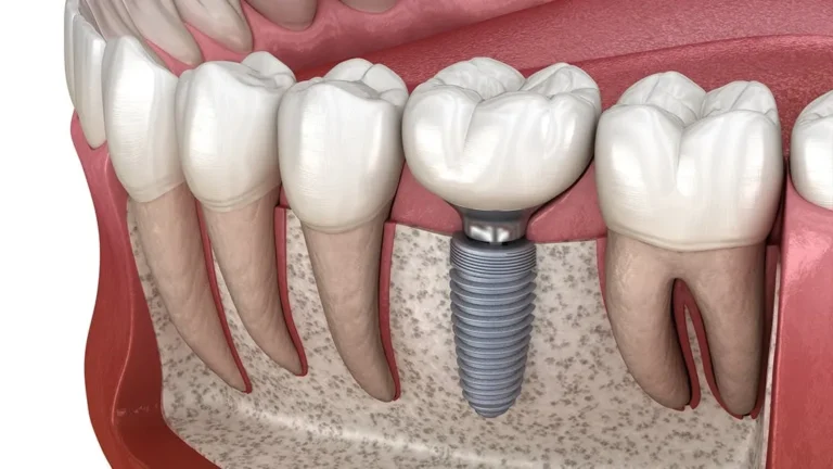 Looking for Dental Implants Brisbane? Warner Lakes Dental Offers Top Solutions